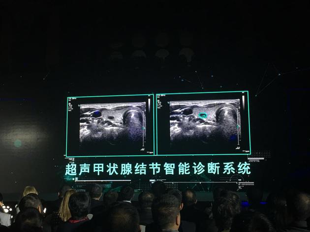 左侧为传统设备影像,医生需通过判断为良性结节。右侧是智能诊断系统自动勾画的影像,与医生判断一致。