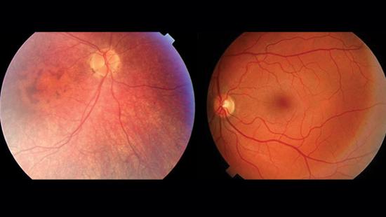 左为LCA患者，右为健康人。两者的视网膜对比，LCA患者的血管组织更少，视网膜更薄，黄斑有所变化，没有中央暗斑。